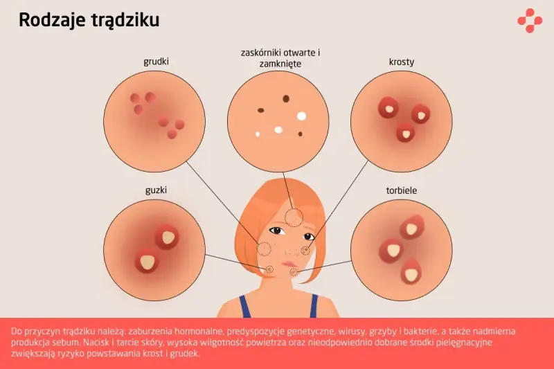 Ilustracja przedstawia różne rodzaje trądziku: grudki, zaskórniki, krosty, guzki i torbiele.